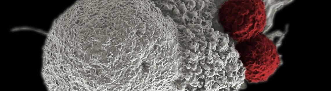 Large, white spongy masses in white of a cancer cell being attacked by 2 red balls representing cytotoxic T cells