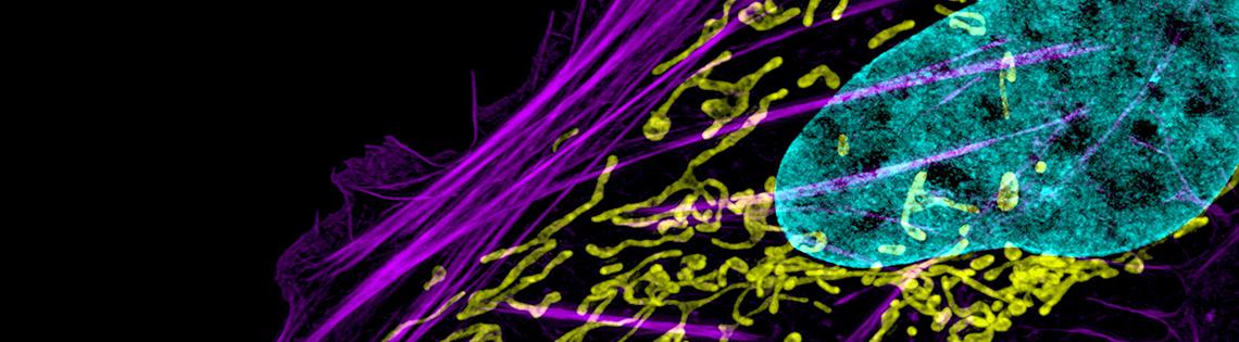 The blue bubble of a cancerous cell surrounded by purple and yellow wisps of cellular parts