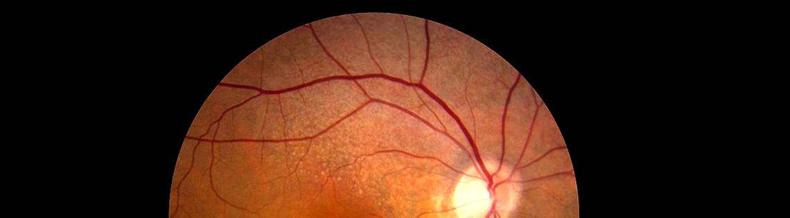 The retina looks like a orange circle with a tiny bright dot in the upper right hand corner. Veins are visible in the photo.