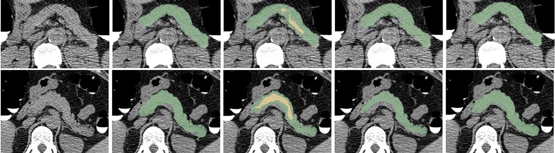 series of CAT scan images of pancreases of 2 patients