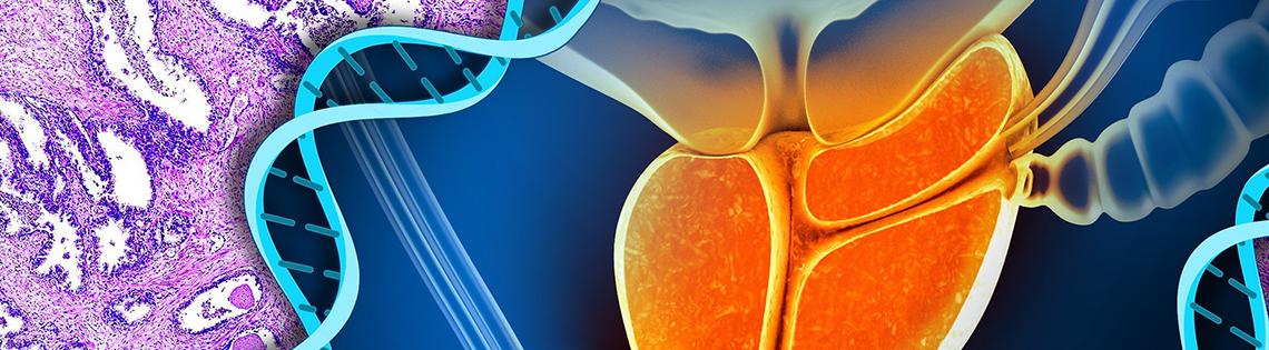 Prostate Cancer: BRCA2 deficiency