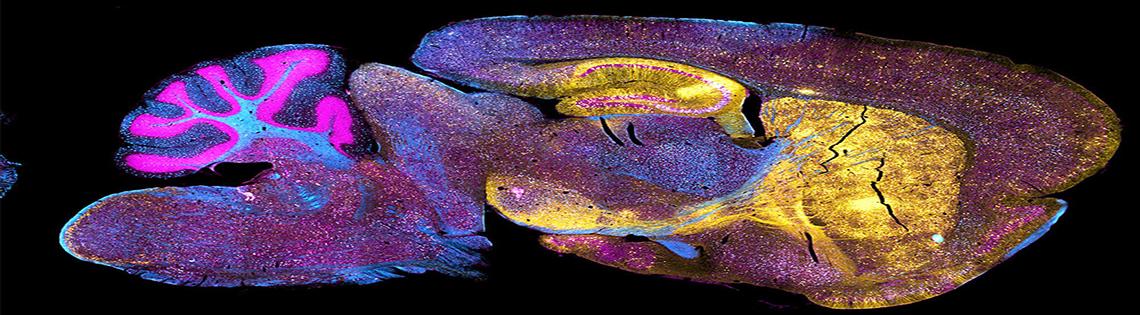 Brain of a mouse with the neurodegenerative disease Niemann-Pick type C1.