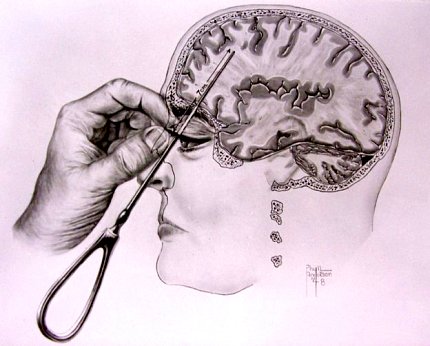 A drawing of hand using Freeman’s icepick-inspired transorbital lobotomy instrument on patient