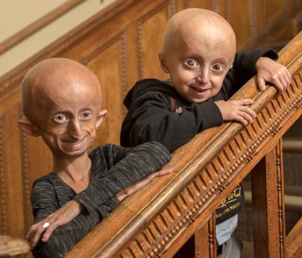 On a staircase, two youngsters who have progeria smile into camera.