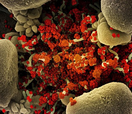 Micrograph of an apoptotic cell (tan) heavily infected with SARS-CoV-2 virus particles (orange),