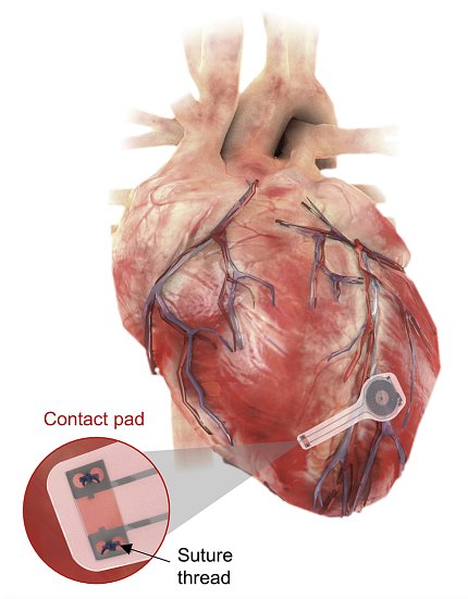 An image of the human heart with a patch, the transient pacemaker, attached to the bottom