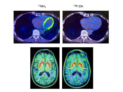 A PET scan of a patent''s heart