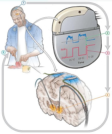 Diagram showing how a device implanted in the brain helps a man slice a vegetable.