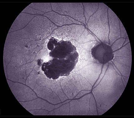 photo of retina resembling a full moon with two dark craters and dark lines stemming from one