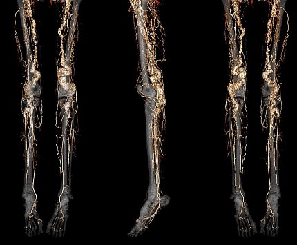 An imaging scan shows vessels in three pairs of legs on black background