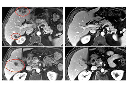 4 PET scans showing a cross-section of a person's body. The 2 left images show lesions on the liver, circled in red. The lesions are much smaller  