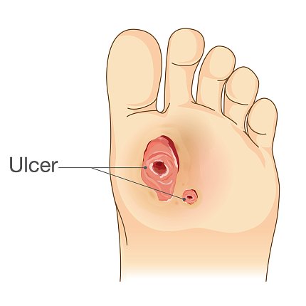 An illustration of an ulcer on the bottom of a foot
