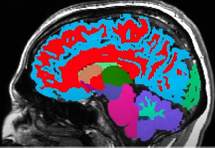 A brain scan, side view of brain, with different colors throughout brain regions