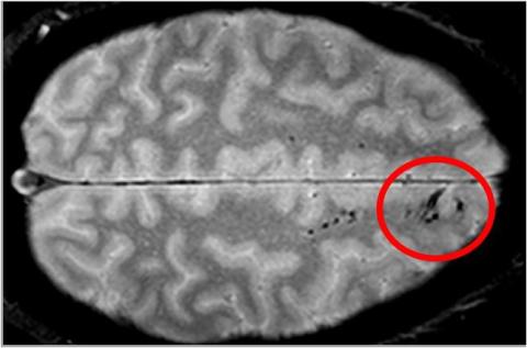 An MRI scan shows black spots on a section of the brain, circled in red.