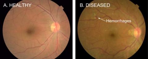 A translucent eyeball that's healthy next to a diseases eyeball with red spots representing hemorrhages, a sign of diabetic retinopahty
