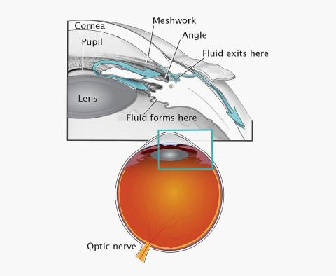 An orange eyeball points to the optic nerve and meshwork that affects the eye's drainage.