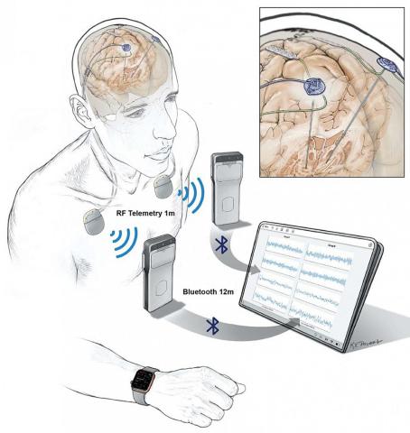 Illustration of brain inside a human head. Devices in foreground are shown to be receiving data from electrodes communicating with the brain's activity.