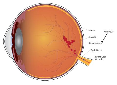 A side view of the eye--a large, orange ball with a cluster of red dots on the retinal vein