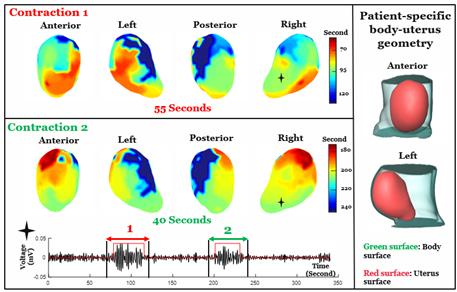 Comparisons of imaged contractions: Different colors show where in the uterus the contraction begins.