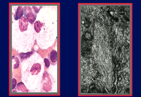 Two microscope images on a dark purple PowerPoint slide. The left image shows white cells in a faint pink background; each cell contains a pinkish-purple nucleus. The grayscale image on the right shows wrinkled, tubular structures in the interior of a cell's lysosome.