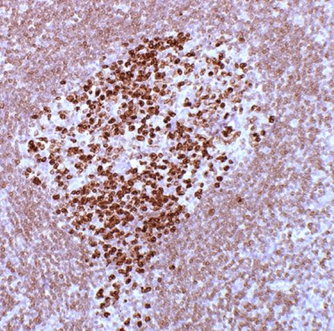 Microscopic image of in situ follicular lymphoma