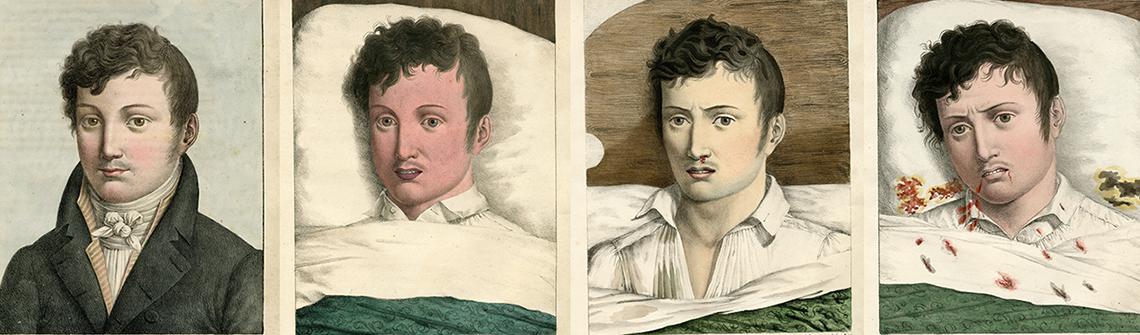 Four drawings showing the progression of yellow fever in a patient.