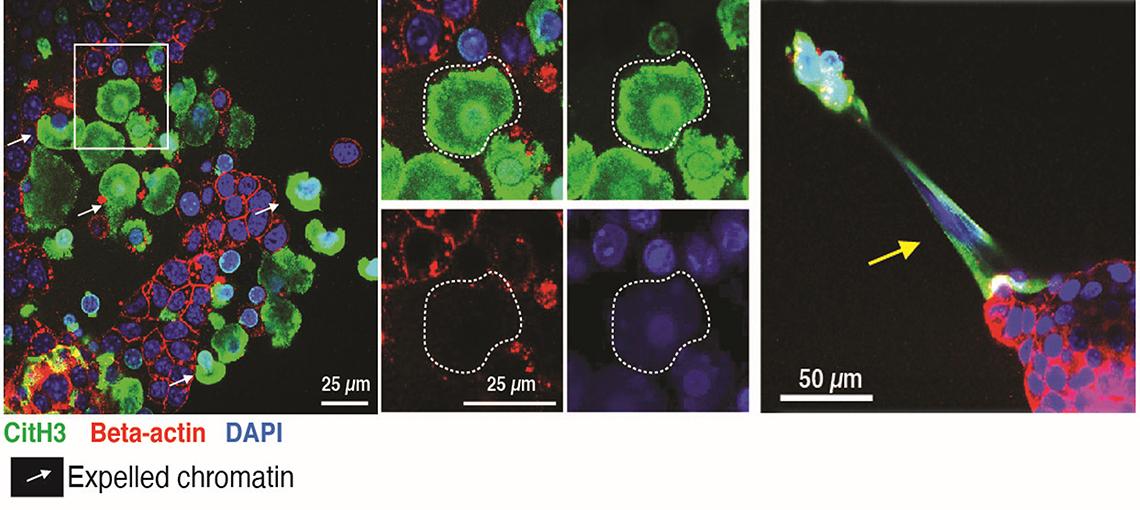 An image shows cancer cells and the expulsion of cell contents in the right panel.