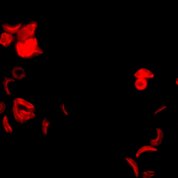 Mixture of normal and sickle-shaped red blood cells on a black background