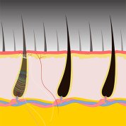 Neuron responds to pulling of single hair.