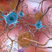 In the Alzheimer’s-affected brain, abnormal levels of the beta-amyloid protein and tau protein accumulate.