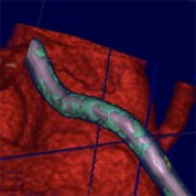 An artery covered in green from plaque crosses over a 3D model heart shown in red.