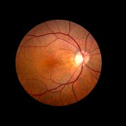 The retina looks like a orange circle with a tiny bright dot in the upper right hand corner. Veins are visible in the photo.
