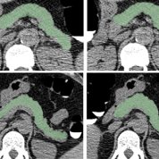 series of CAT scan images of pancreases of 2 patients