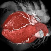 A medical image of a heart muscle