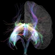 scientific image of the brain with white gossamer-like circuitry 