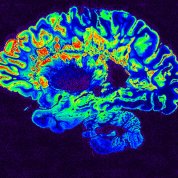 Brain scan image colored blue with several areas highlighted in green and orange