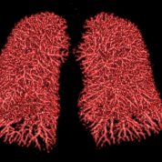 Computed tomography 3D rendering of the lungs of a person who is recovering from Covid-19.