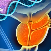 Prostate Cancer: BRCA2 deficiency