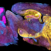 An image of a mouse brain with neurodegenerative disease Niemann-Pick type C1.