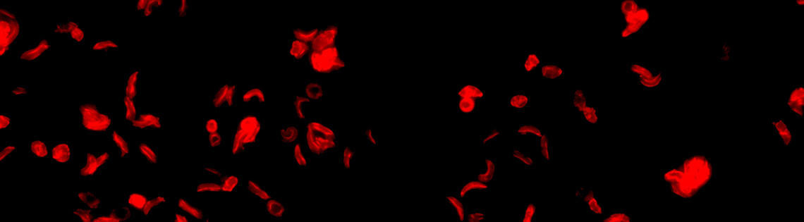 Mixture of normal and sickle-shaped red blood cells on a black background
