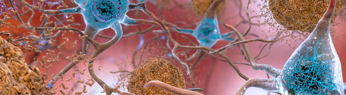 In the Alzheimer’s-affected brain, abnormal levels of the beta-amyloid protein and tau protein accumulate.