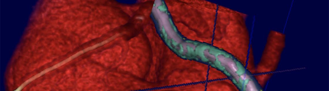 An artery covered in green from plaque crosses over a 3-dimensional model heart shown in red