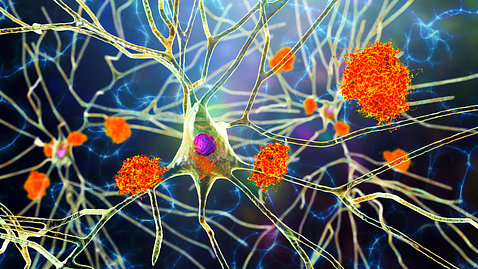 Large clumps of orange attach to interconnected branches--the neurons in the brain.