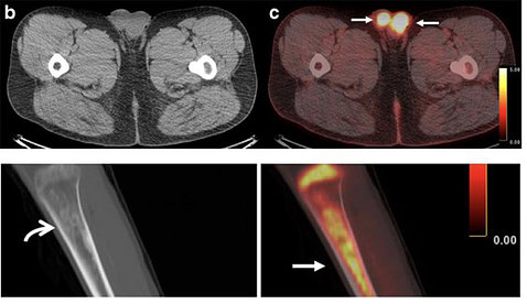 Side-by-side images of the same chest and limb show arrows pointing to glowing masses, tumors that appeared on PET but not on CT scan.