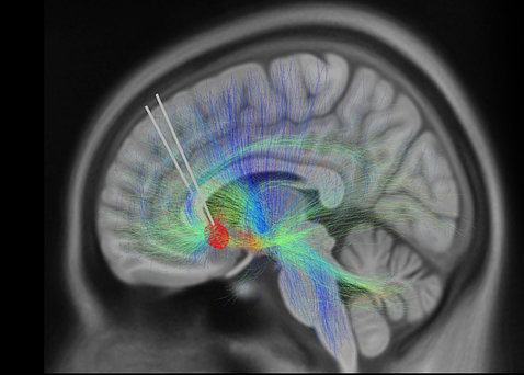 A brain image of twoimplanted DBS leads