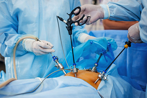 The hands and torsos of two surgeons, holding surgical tools over the exposed abdomen of a patient.