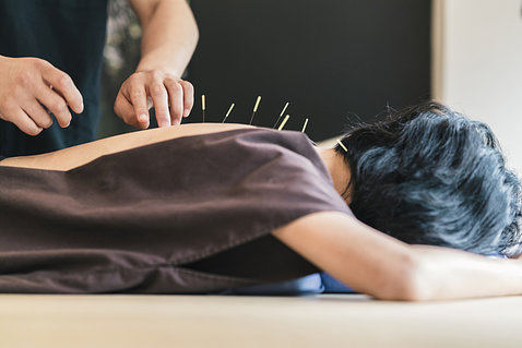 Patient laying on their stomach with acupuncture needles in their upper back. 
