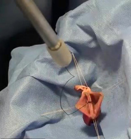 A metal stick with thread is making a stitch in pink piece of tissue.