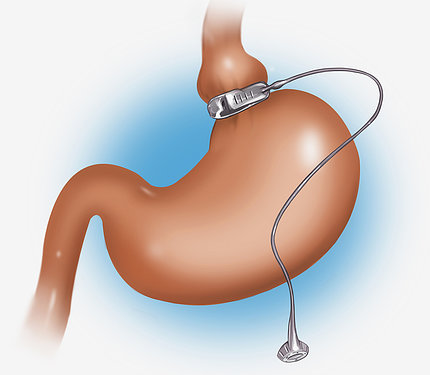Illustration of gastric band weight loss surgery.