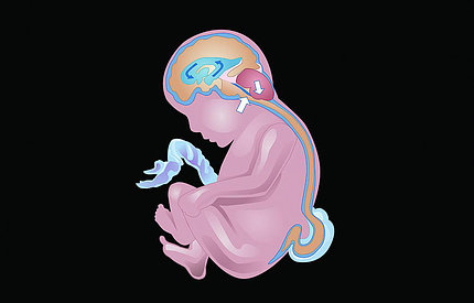 Illustration of fetus with spinal defect